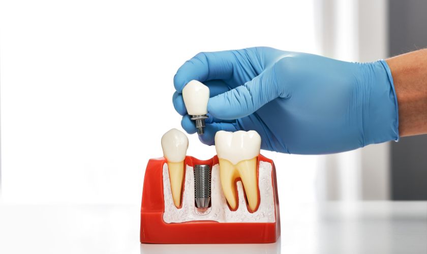 Get the Perfect Smile with Dental Implants in Camp Springs