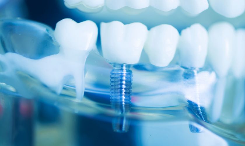 Dental Implants Camp Springs