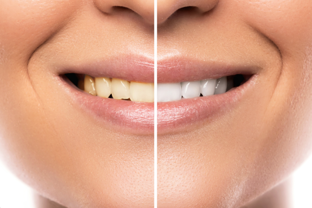 Why It is Never Too Late for Teeth Whitening Treatments