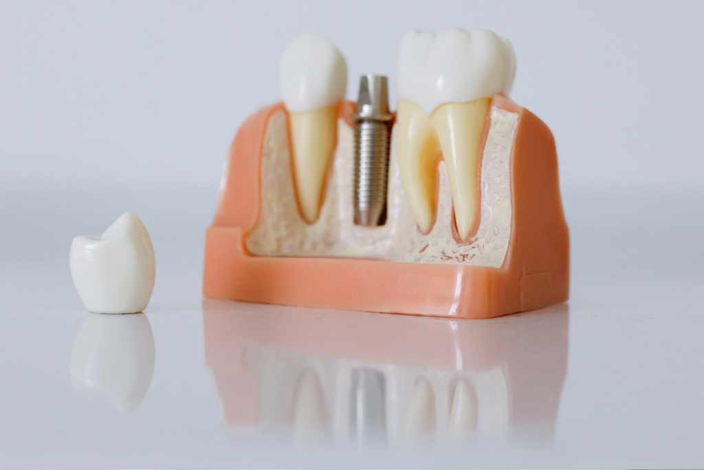 Dental Implants: Best Option for Missing Teeth