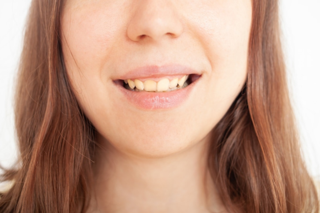 Causes of Teeth Stains and How to Prevent Them