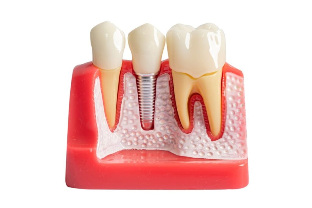 dental implants in camp springs