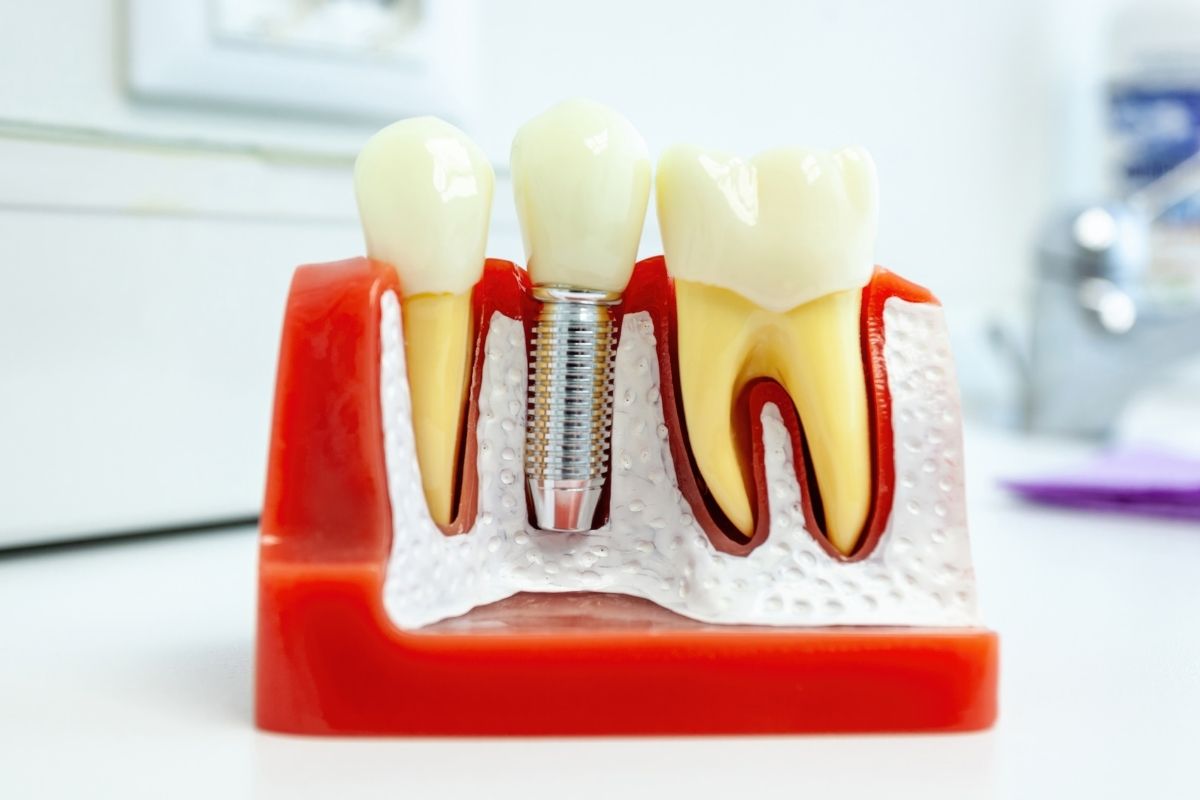 dental implants camp springs
